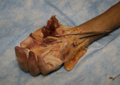 Cadaver Testing of the Carpal Tunnel